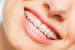 Patient smiling with tooth-colored brackets and wires